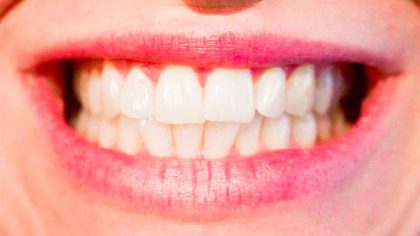 odontoiatria-ortodonzia-carie-test-salivari